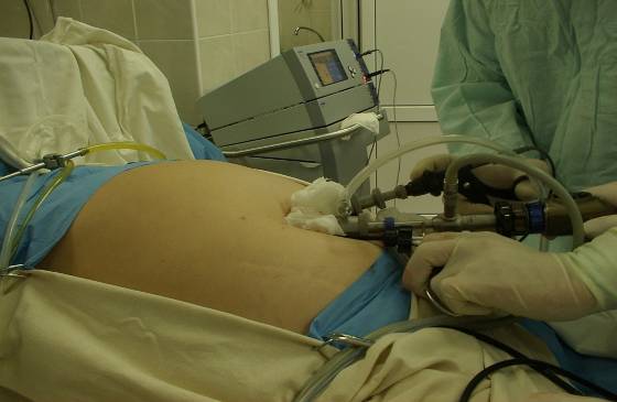 Лапароскопия желчного пузыря в санкт петербурге можно ли вылечить хронический холецистит навсегда