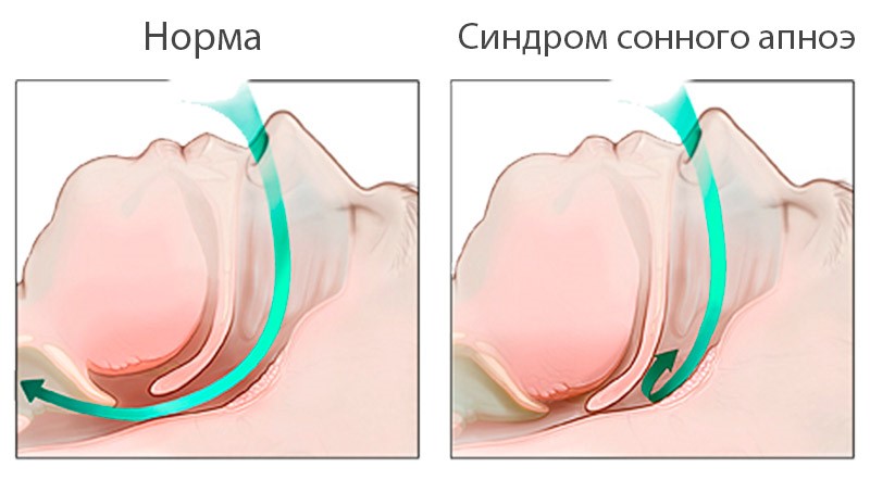 Лечение и диагностика синдрома обструктивного апноэ сна в СПб больнице РАН